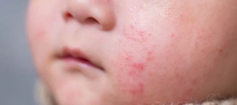 How to Distinguish Rash-Related Diseases in Children?
