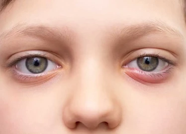What to Do If Your Child Frequently Gets a Stye?