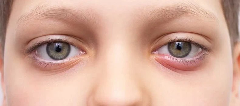 What to Do If Your Child Frequently Gets a Stye?