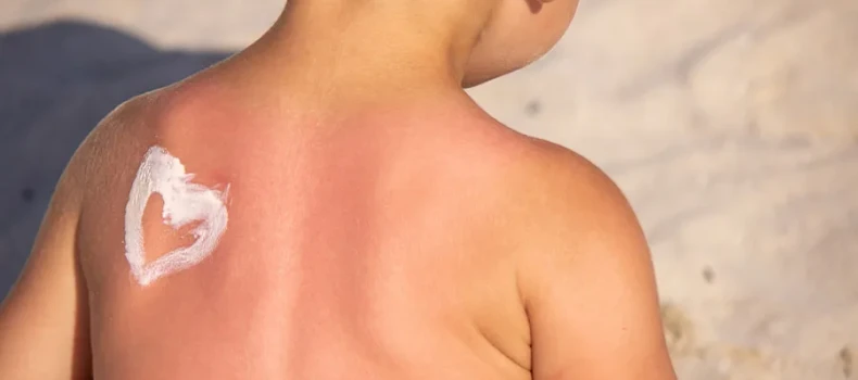 Sunburn in Children: Prevention Tips and Home Care