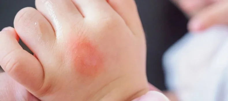 Preventing Insect and Mosquito Bites in Children: What Parents Should Know
