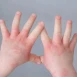 Common Types of Eczema in Childhood and Skincare Recommendations