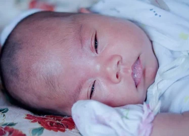Skin Color Changes and Cyanosis in Newborns
