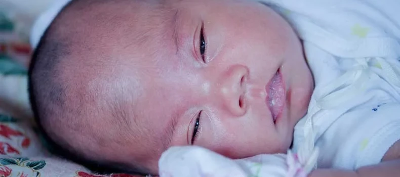 Skin Color Changes and Cyanosis in Newborns