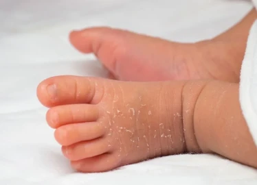 Yenidoğanlarda Ciltte Soyulma ve Kuruluk Ne Zaman Geçer?
