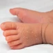 Yenidoğanlarda Ciltte Soyulma ve Kuruluk Ne Zaman Geçer?