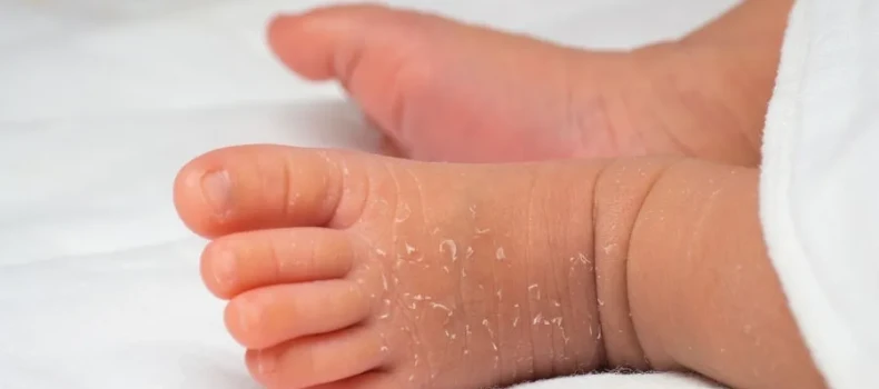 Yenidoğanlarda Ciltte Soyulma ve Kuruluk Ne Zaman Geçer?