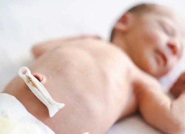 Umbilical Cord Detachment and Care in Newborns